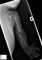 Severe first metacarpal hypoplasia