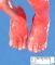 First toe hypoplasia (hallux hypoplasia)