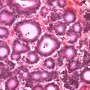 Pancreatic acinar cell carcinoma