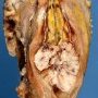 Tibial osteosarcoma with invasion of soft tissues