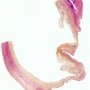 Aortic dissection in Marfan disease