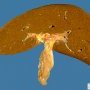 Cholestatic liver