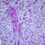 Polyglycosan inclusions in glycogen storage disease type 4 (GSD4)