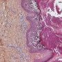 Epidermolytic hyperkeratosis