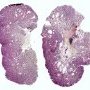 Colorectal tubulous adenoma