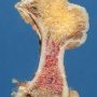 osteochondroma_06_
