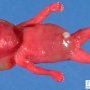 Cystic hygroma in Turner syndrome (18 weeks)