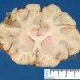 Brain frontal sections