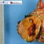 Chromophobe renal cell carcinoma