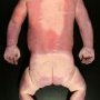 Acrania in anencephaly (40 weeks)