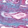 Renal interlobular artery with mucoid intimal thickening (malignant (...)