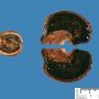 Intestinal intussuspection and infarction on Meckel diverticula