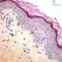 Griscelli syndrome - Skin