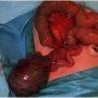 Intestinal duplication
