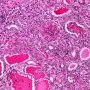 WT1-associated diffuse mesangial sclerosis