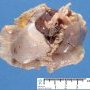 Extralobar pulmonary sequestration