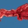 Crohn ileitis (Ileal Crohn disease)