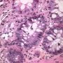 Colonic GVH