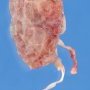 Unique obstructive right kidney with left renal agenesis