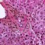 Epithelial dysplasia of interlobular biliary tract in chronic hepatic (...)