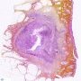 Pilonidal sinus cyst