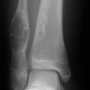 Multiple metaphyseal fibrous defects