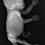 D12-L2 ertebral anomalies and abdominal calcifications