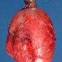 Duodenal duplication cyst