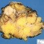Infiltrating ductular mammary carcinoma