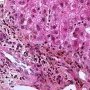 Epithelial dysplasia of interlobular biliary tract in chronic hepatic (...)