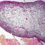 Embryonal botryoid rhabdomyosarcoma of the rhinopharynx
