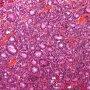 Pancreatic acinar cell carcinoma
