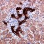 Ductular reaction or ductular proliferation (cytokeratin-7)