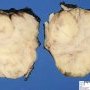 Mammary fibroadenoma