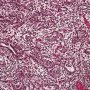 Candida fetal pneumonitis