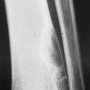 Metaphyseal fibrous defect