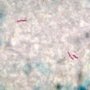 Ziehl–Neelsen stain (Courtesy of Dr Yale Rosen)