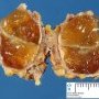 Thyroglossal tract cyst