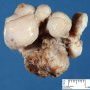 Juvenile angiofibroma