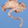 Ileal duplication cyst