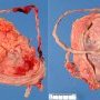 Long umbilical cord (54 cm for normal at 23 cm)