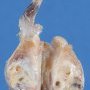 Testicular juvenile-type granulosa tumor