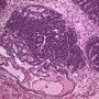 Blastemal component in Wilms tumor