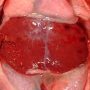 BIlateral nephromegaly in Meckel syndrome