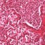 Acute bronchopneumonia