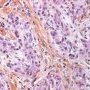Plexiform fibrohistiocytic tumor