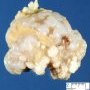 Osteochondroma