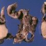 Gastric GIST