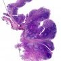 Acute tonsillitis with ulceration