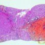 Ductal plate malformation (congenital hepatic fibrosis)